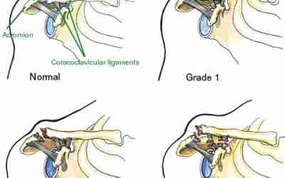 Separated Shoulder Separated Shoulder